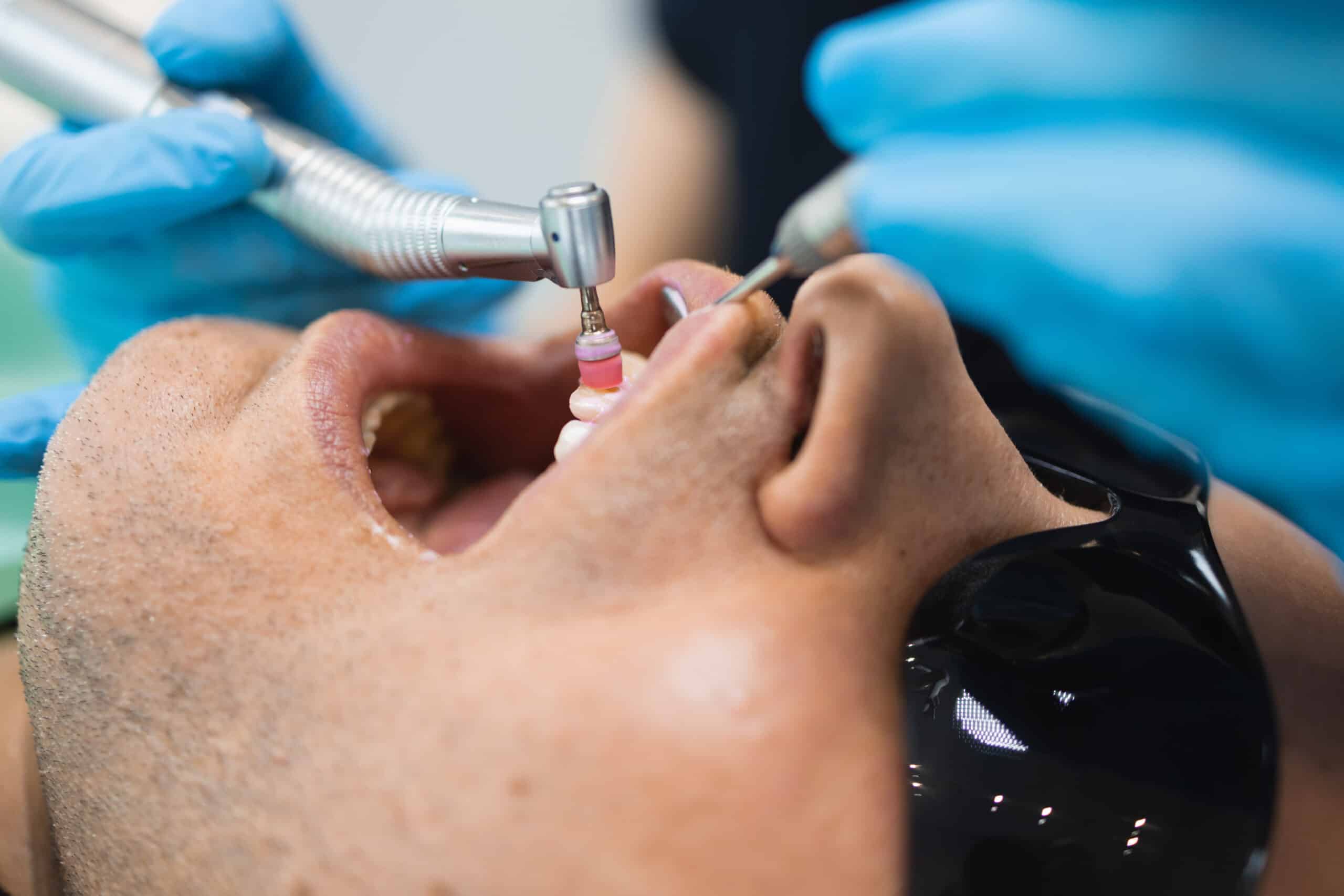 The Benefits of Professional Teeth Cleaning Beyond A Bright Smile