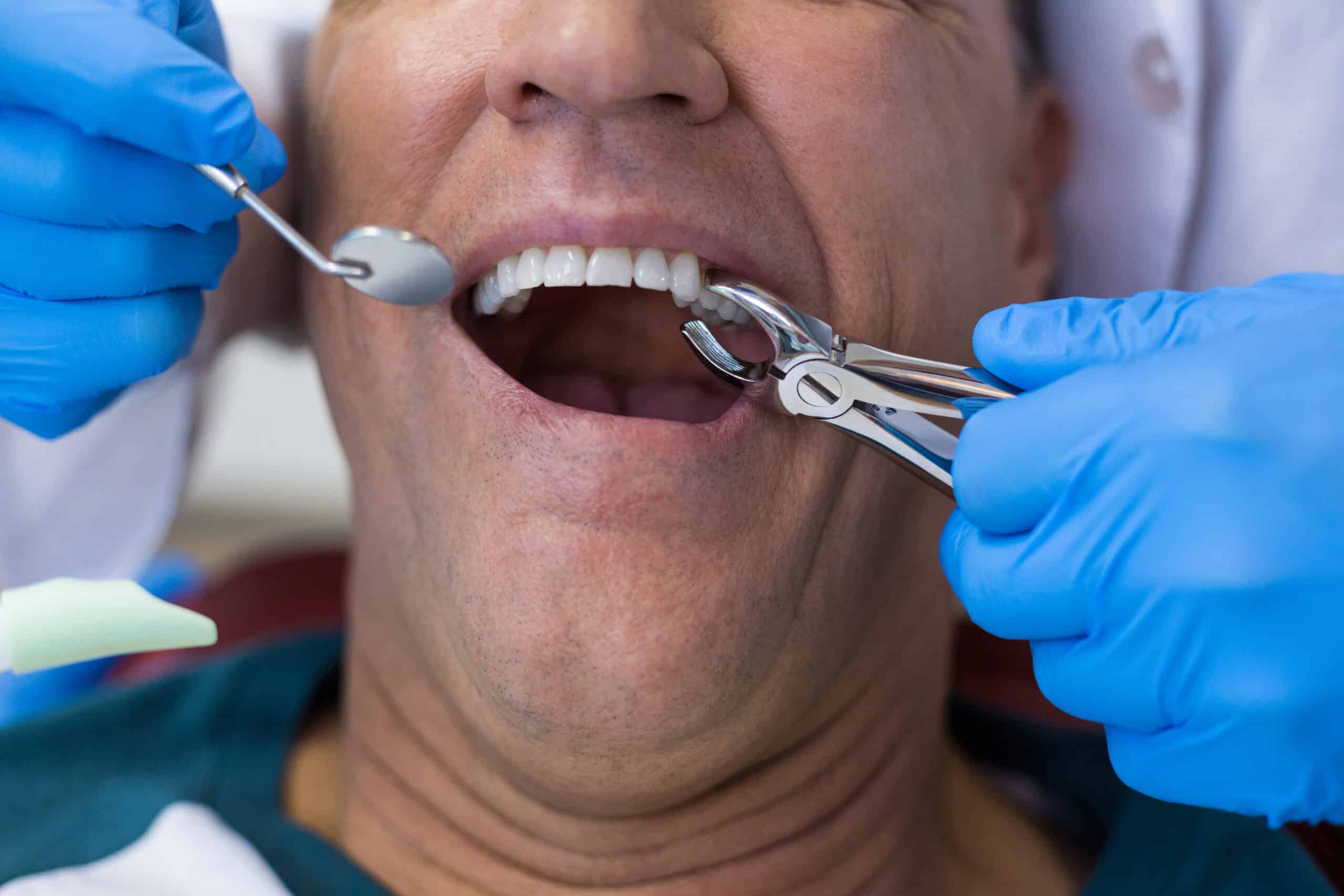 Signs You Need A Tooth Extraction And What To Expect