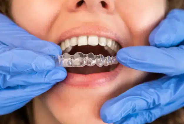 Clear Aligners in Plant City, FL - Horizon Dental Designs