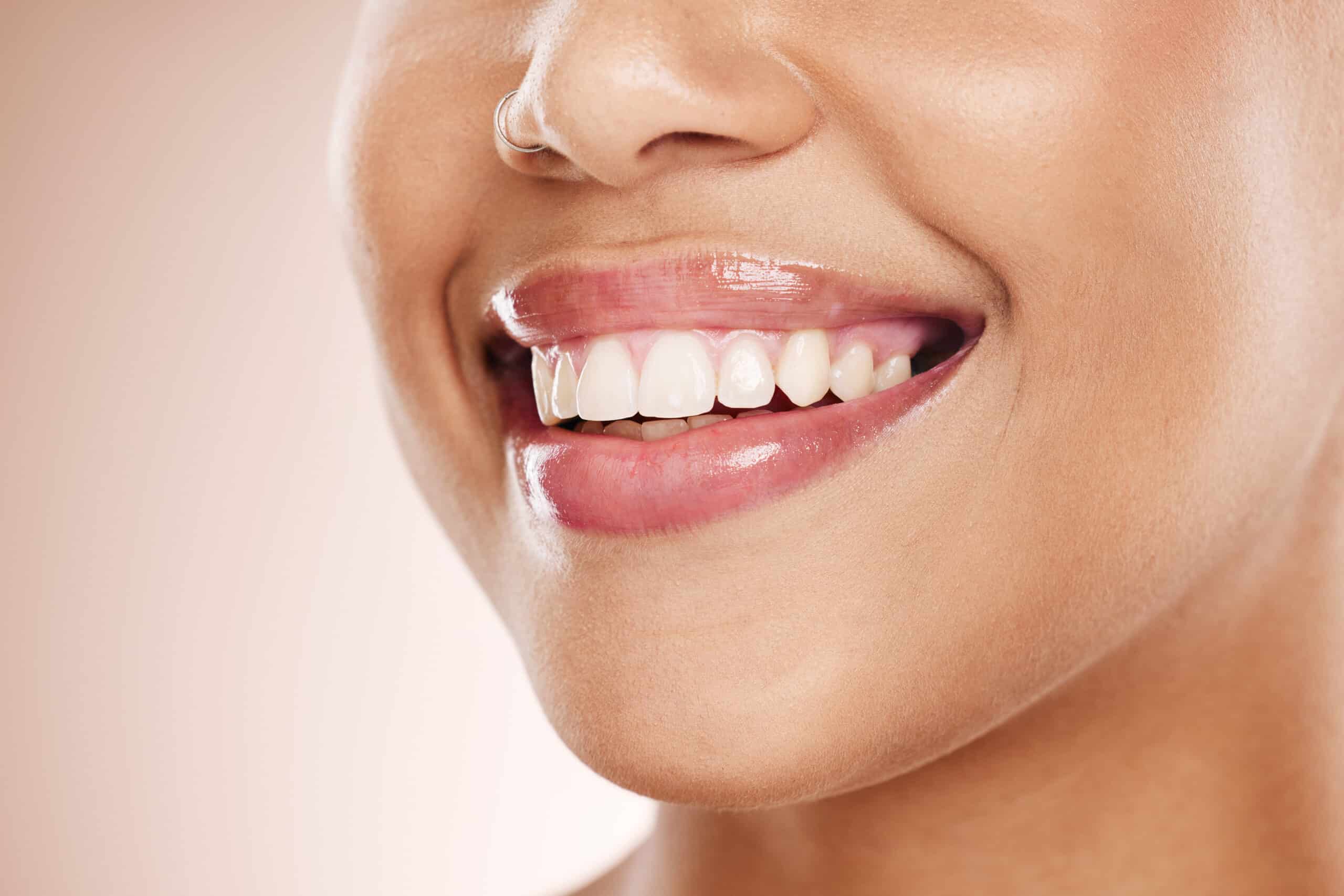 Best Teeth Whitening Routine: How Often Should You Do It?