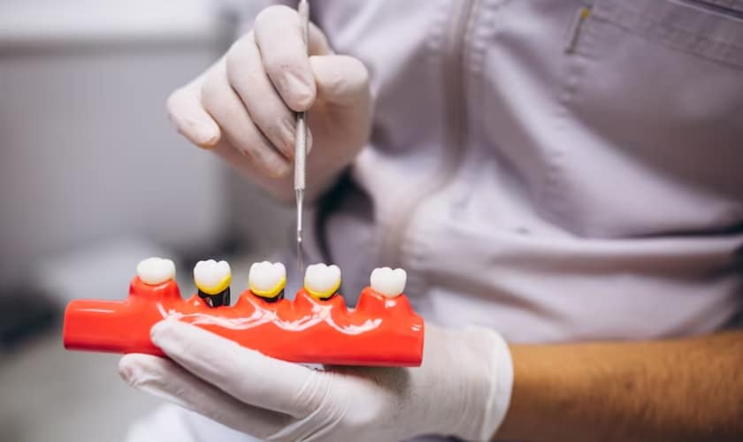 Why Choose Dental Bridges For Replacing Missing Teeth?