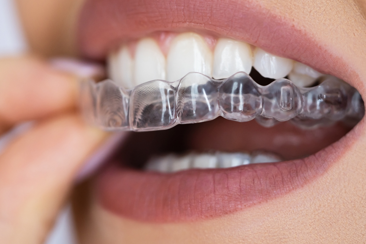 Active Plant City Living: Enjoying Your Favorite Foods &amp; Activities with Removable Clear Aligners