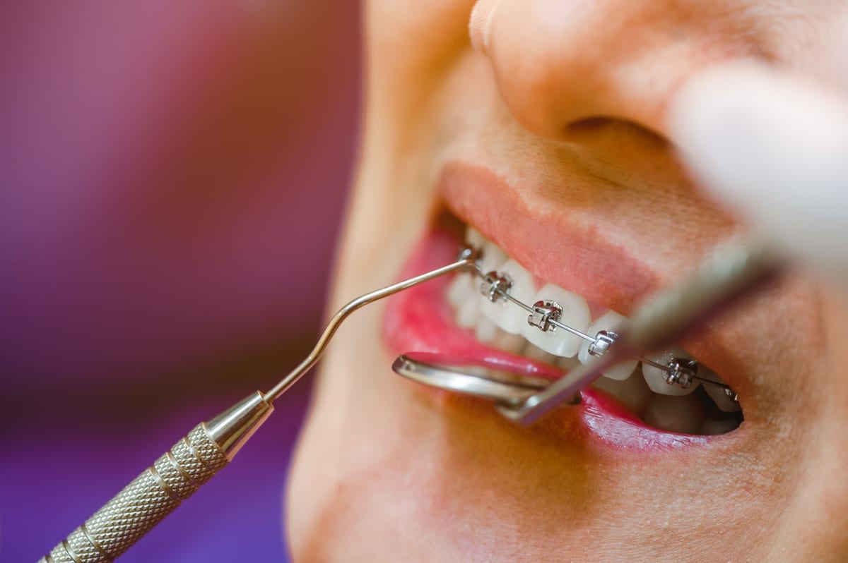 Dental Bridge in Plant City, FL