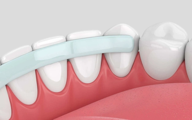 Dental Bonding in Plant City, FL - Horizon Dental Designs