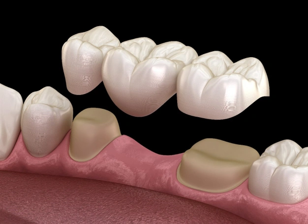 Dental Bridges in Plant City, FL - Horizon Dental Designs