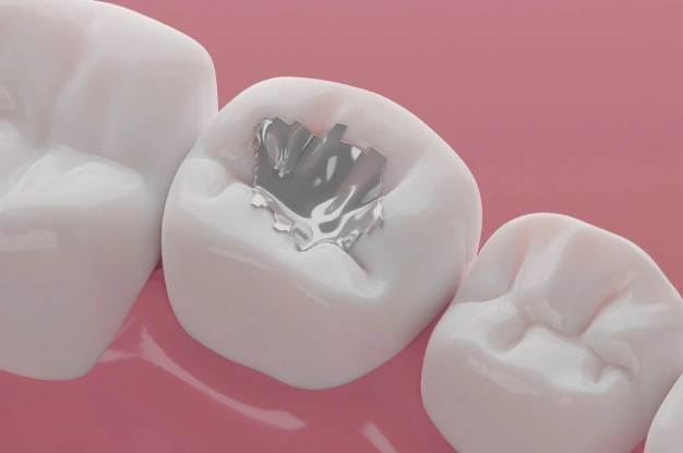 Dental Fillings in Plant City, FL - Horizon Dental Designs