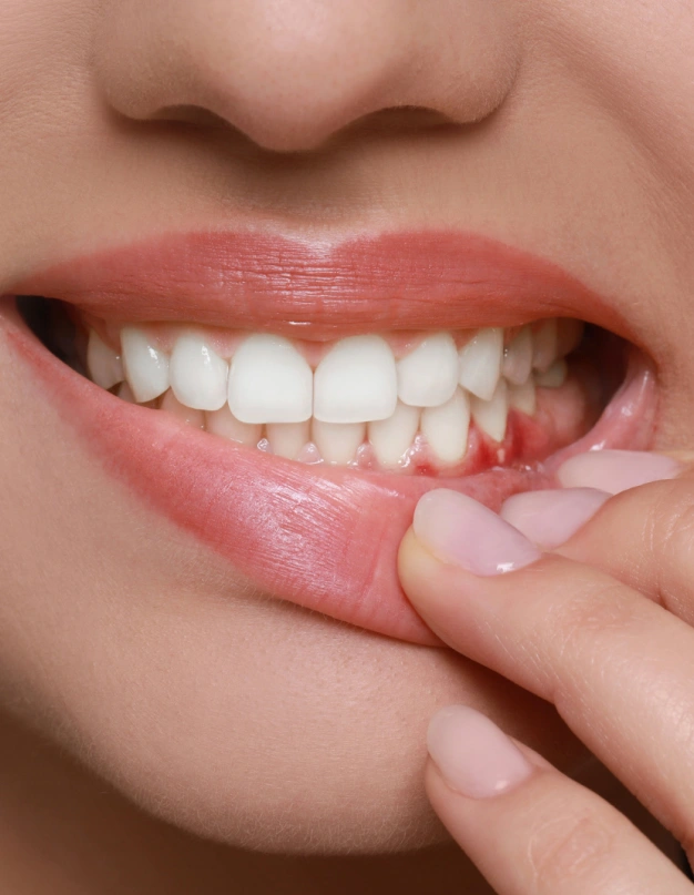 Periodontal Gum Treatments in Plant City, FL - Horizon Dental Designs