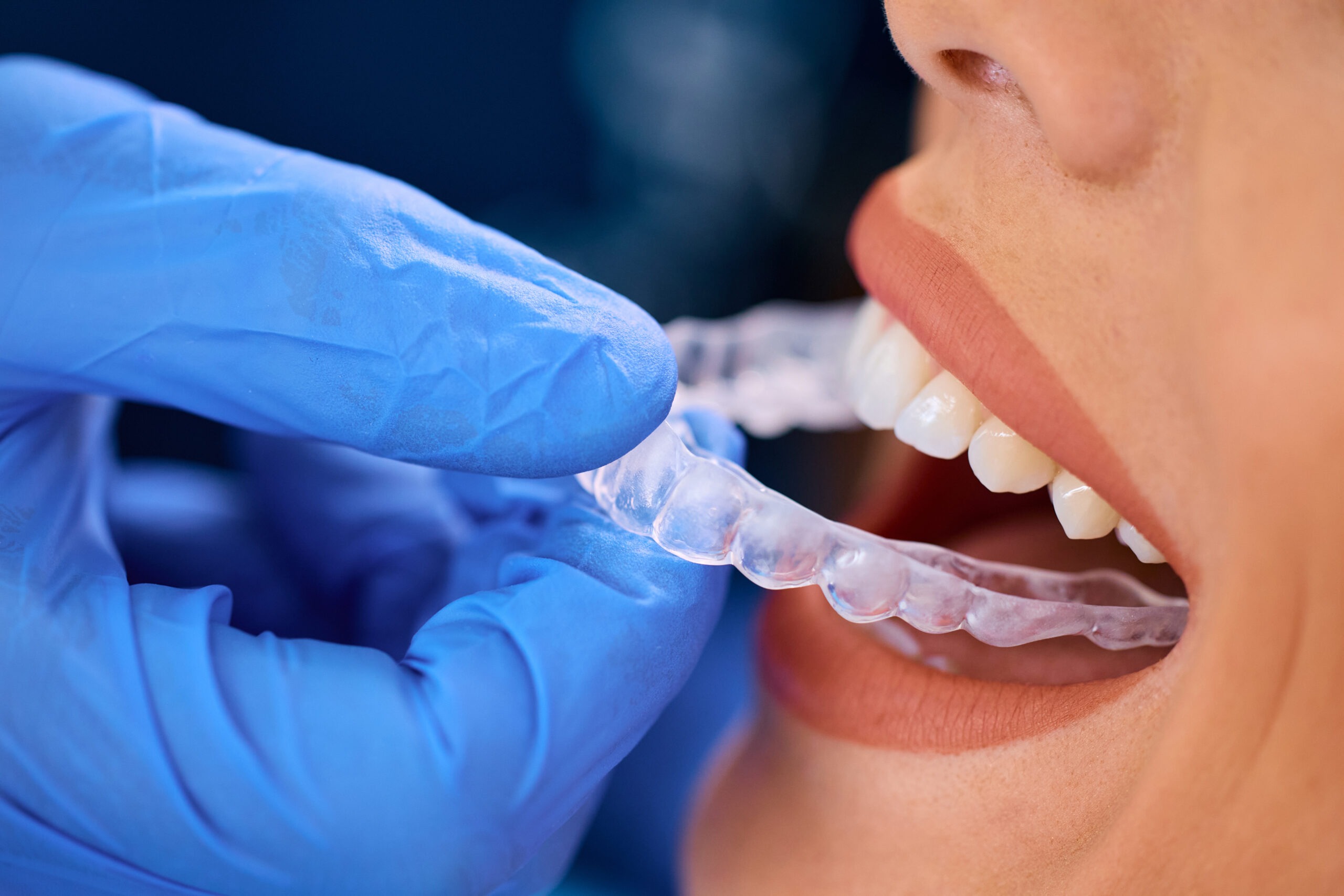 a dentist in Plant City is applying clear, invisible aligners to a woman's teeth.