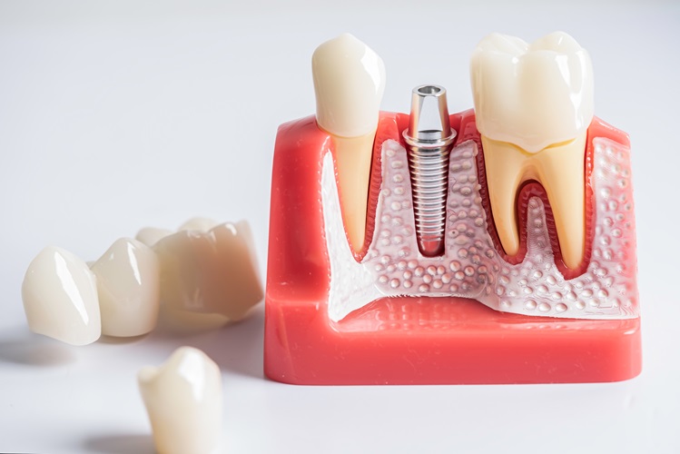 Caring for Your Implant Restoration for Long-Term Success