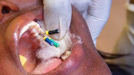 How Long Do Dental Crowns Last?